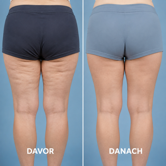 Formkur - Anti-Cellulite- & Bindegewebs-Massagegerät